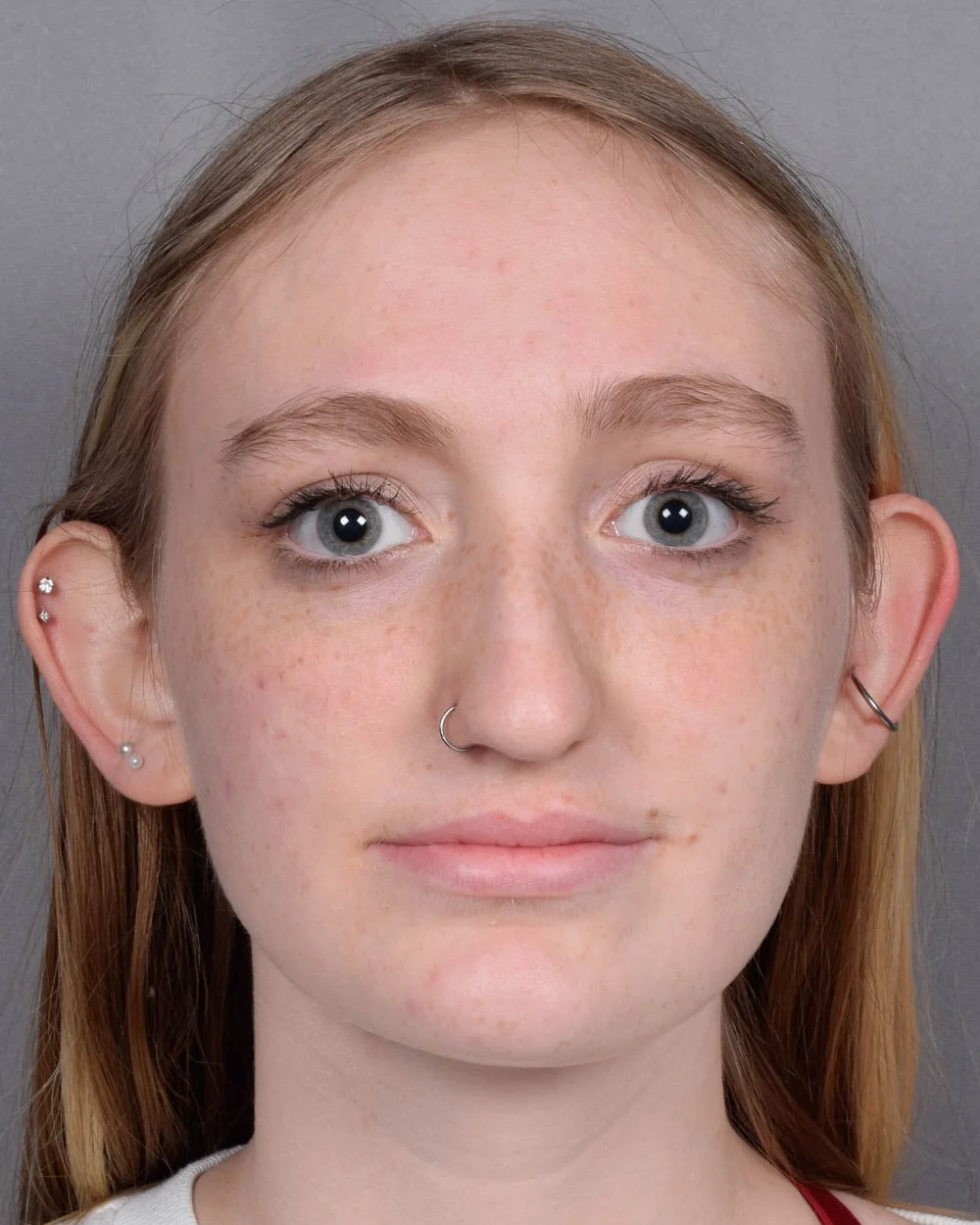 Before Rhinoplasty Profile Smiling - Vegas Facial Plastics, Mehdi Sina, MD