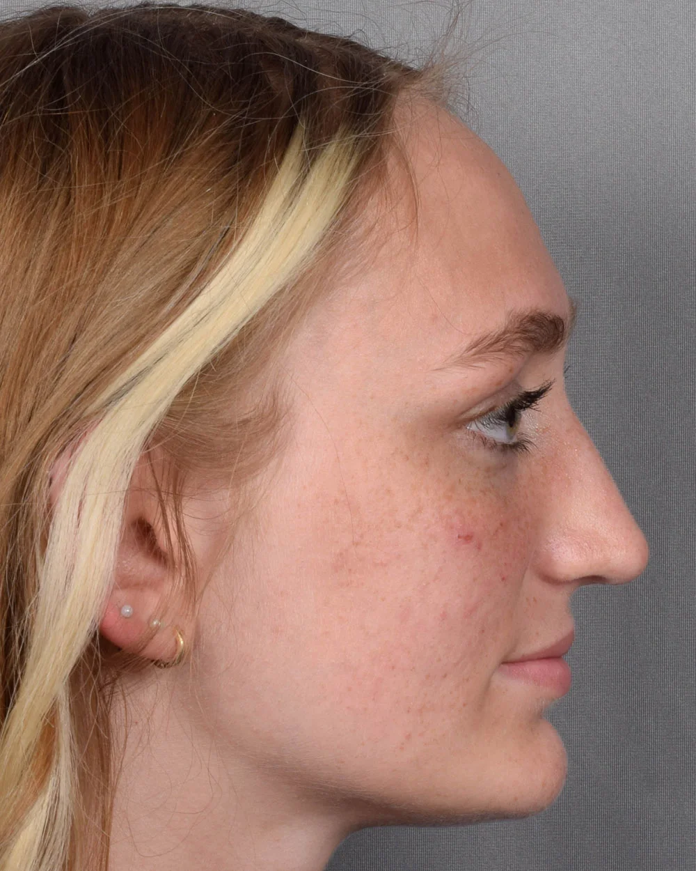 After Rhinoplasty Profile - Vegas Facial Plastics, Mehdi Sina, MD