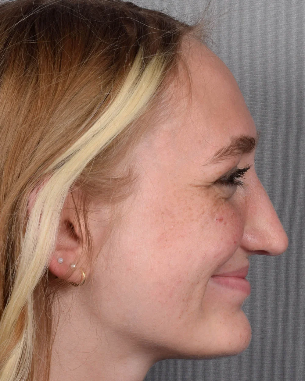 After Rhinoplasty Profile Smiling - Vegas Facial Plastics, Mehdi Sina, MD
