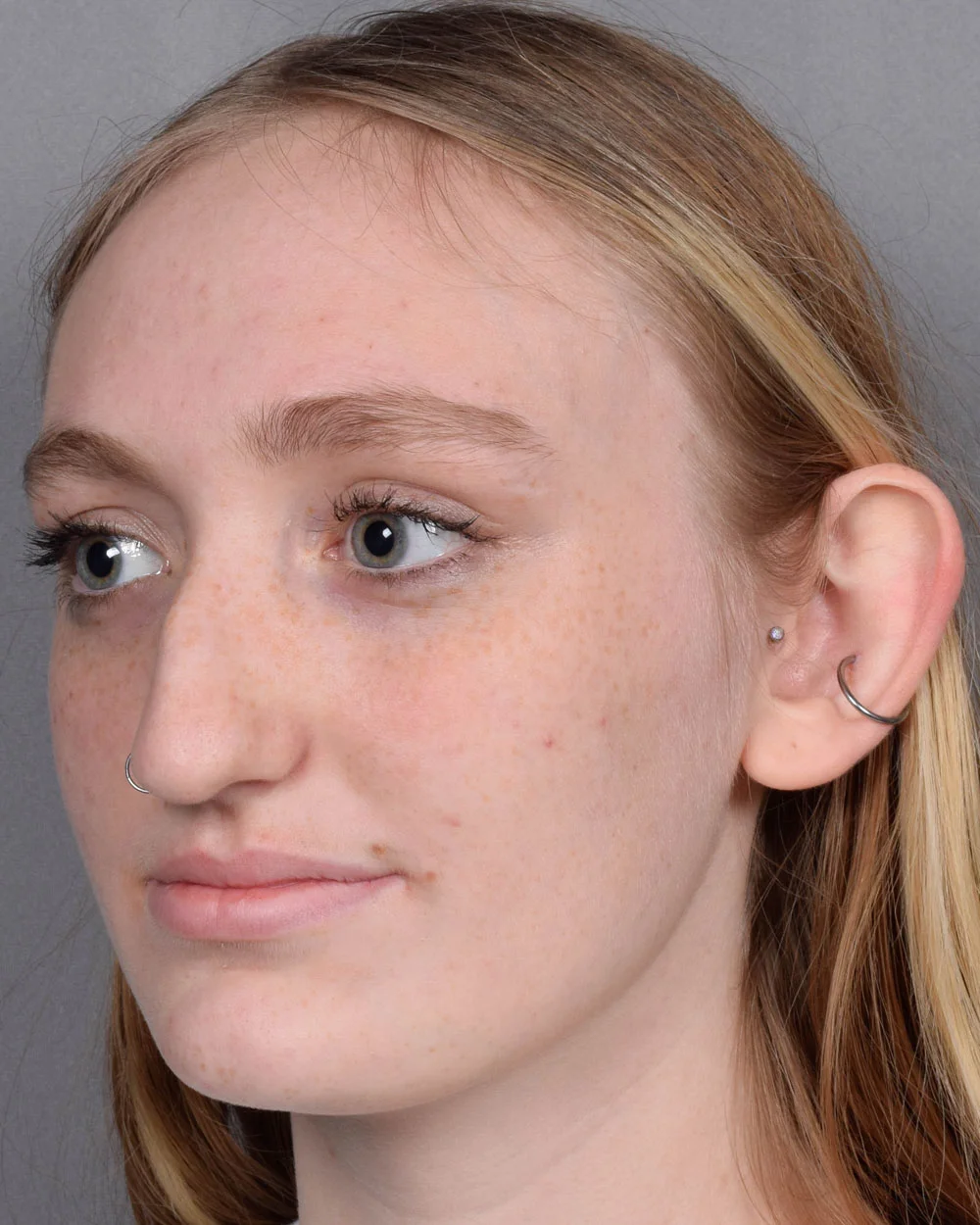 Before Rhinoplasty Oblique - Vegas Facial Plastics, Mehdi Sina, MD