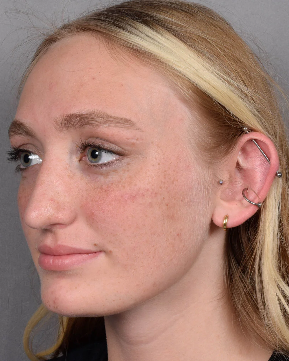 After Rhinoplasty Oblique - Vegas Facial Plastics, Mehdi Sina, MD