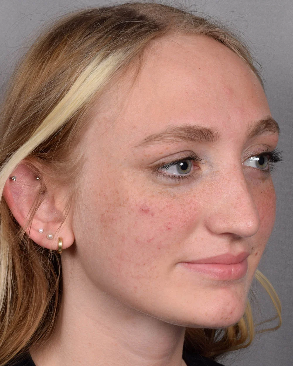 After Rhinoplasty Oblique - Vegas Facial Plastics, Mehdi Sina, MD