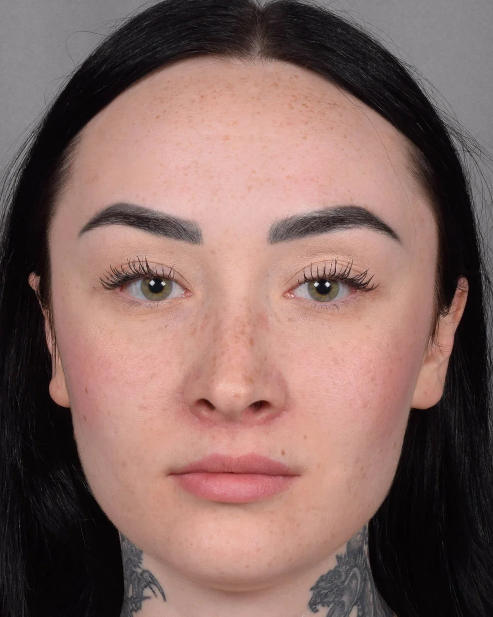 After Lip Lift - Vegas Facial Plastics, Mehdi Sina, MD