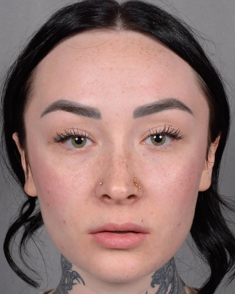 Before Lip Lift, lips parted - Vegas Facial Plastics, Mehdi Sina, MD