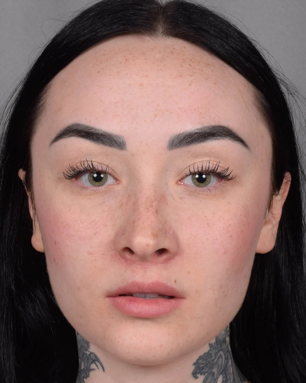 After Lip Lift, lips parted - Vegas Facial Plastics, Mehdi Sina, MD