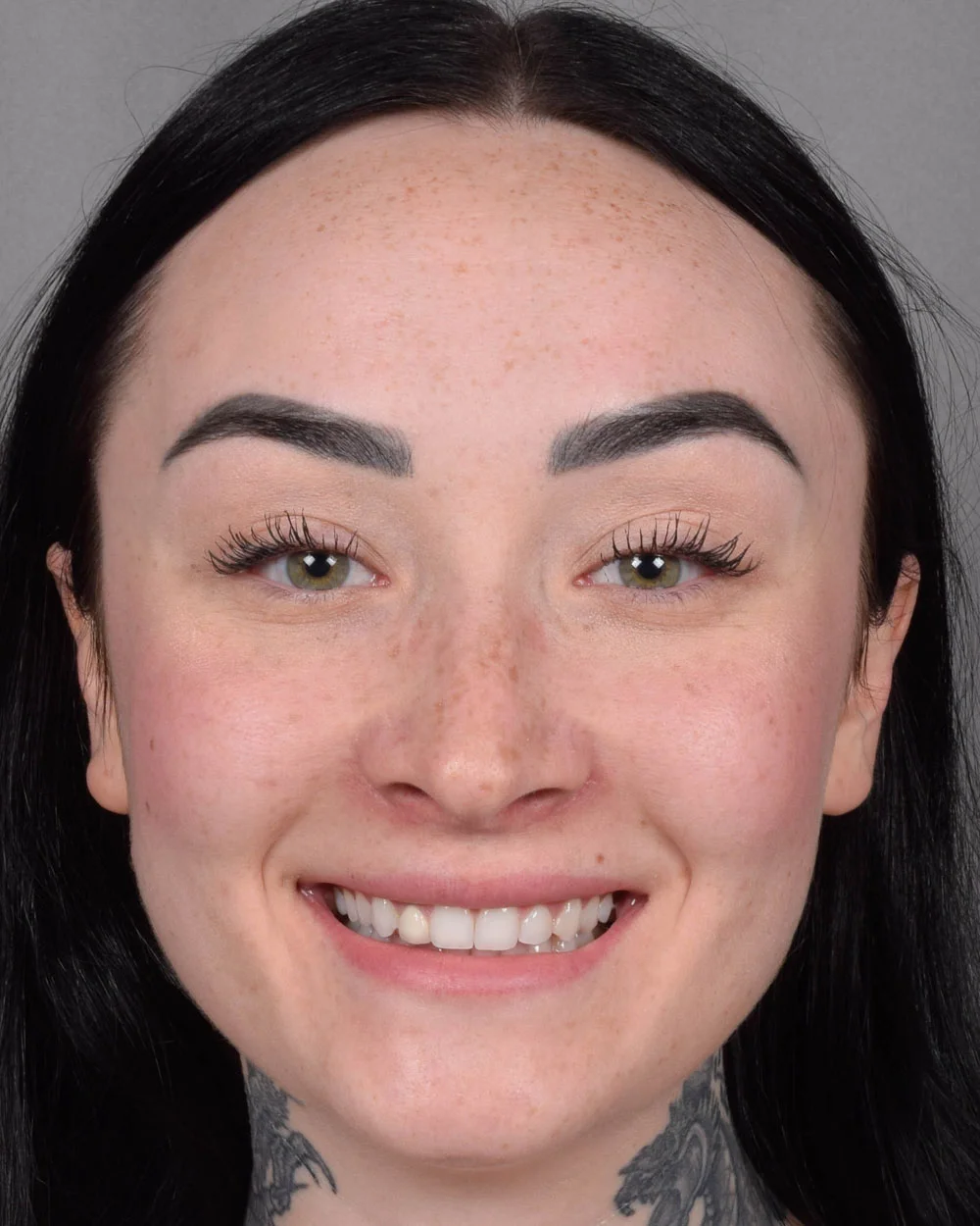 After Lip Lift, Smiling - Vegas Facial Plastics, Mehdi Sina, MD