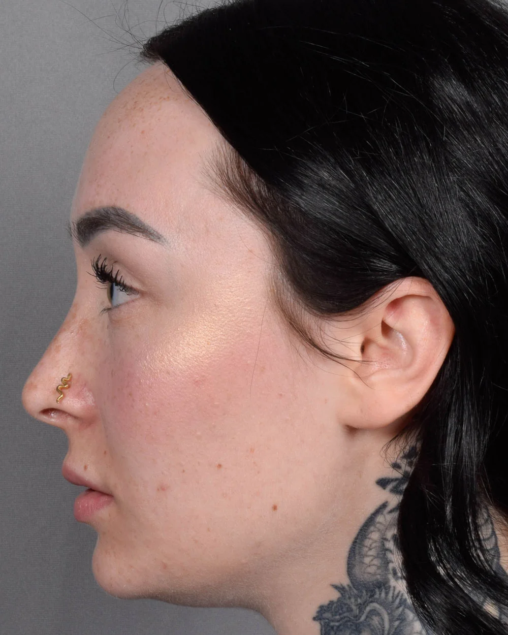 Before Lip Lift, Profile - Vegas Facial Plastics, Mehdi Sina, MD