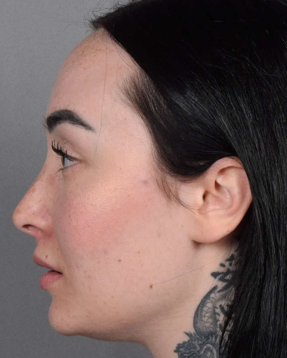 After Lip Lift, Profile - Vegas Facial Plastics, Mehdi Sina, MD