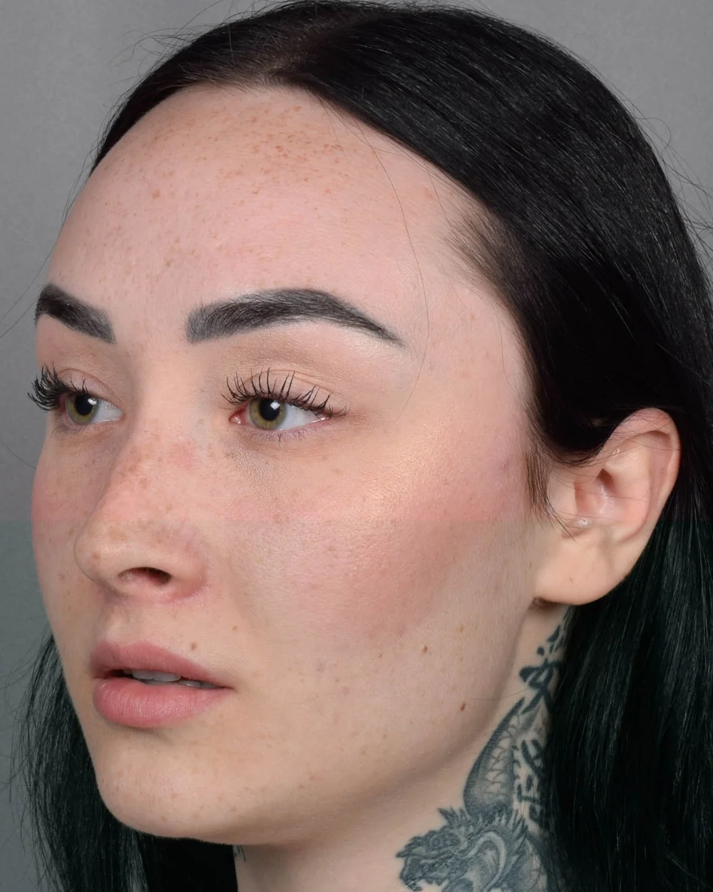 After Lip Lift, Oblique - Vegas Facial Plastics, Mehdi Sina, MD