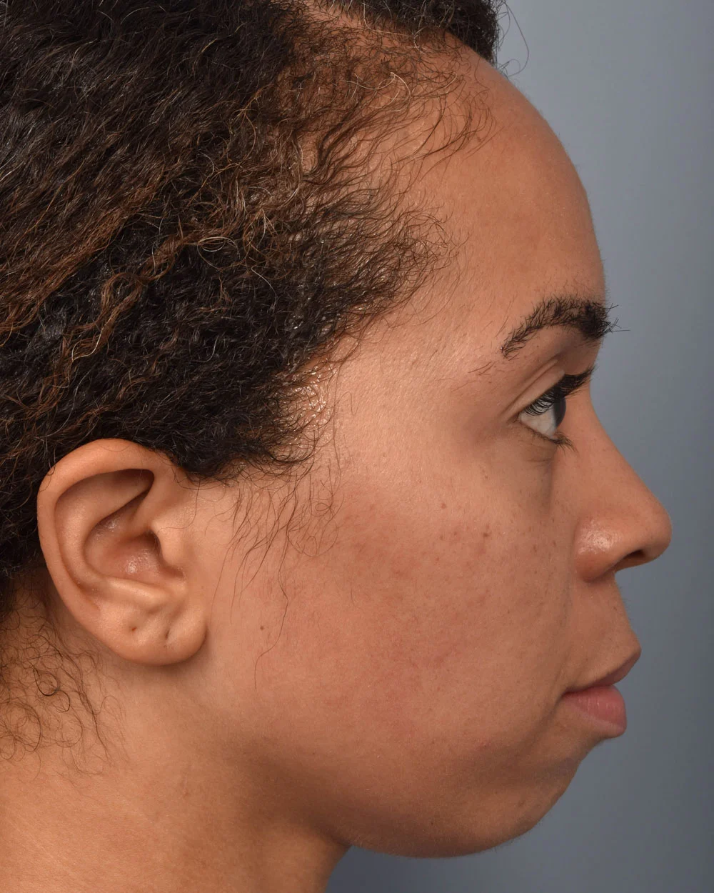 Before Lower Blepharoplasty Profile - Vegas Facial Plastics, Mehdi Sina, MD