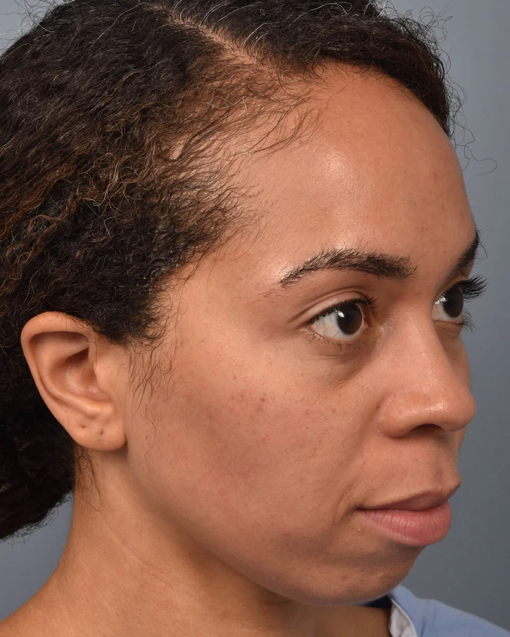 Before Lower Blepharoplasty Oblique - Vegas Facial Plastics, Mehdi Sina, MD