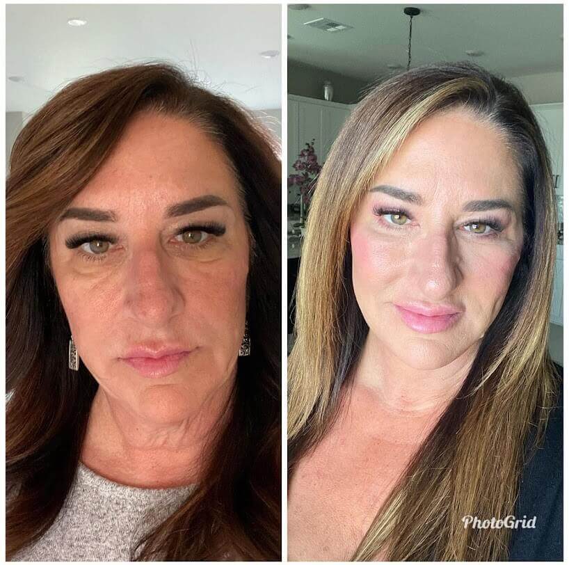 Actual patient - facelift, neck lift, blepharoplasty, co2