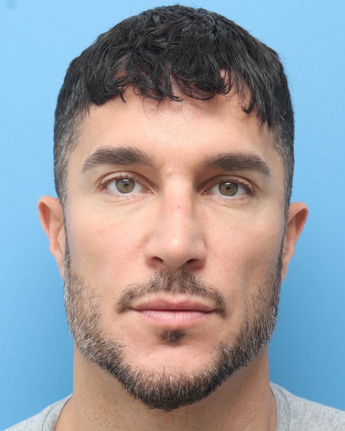 After Male Rhinoplasty - Vegas Facial Plastics, Mehdi Sina, MD