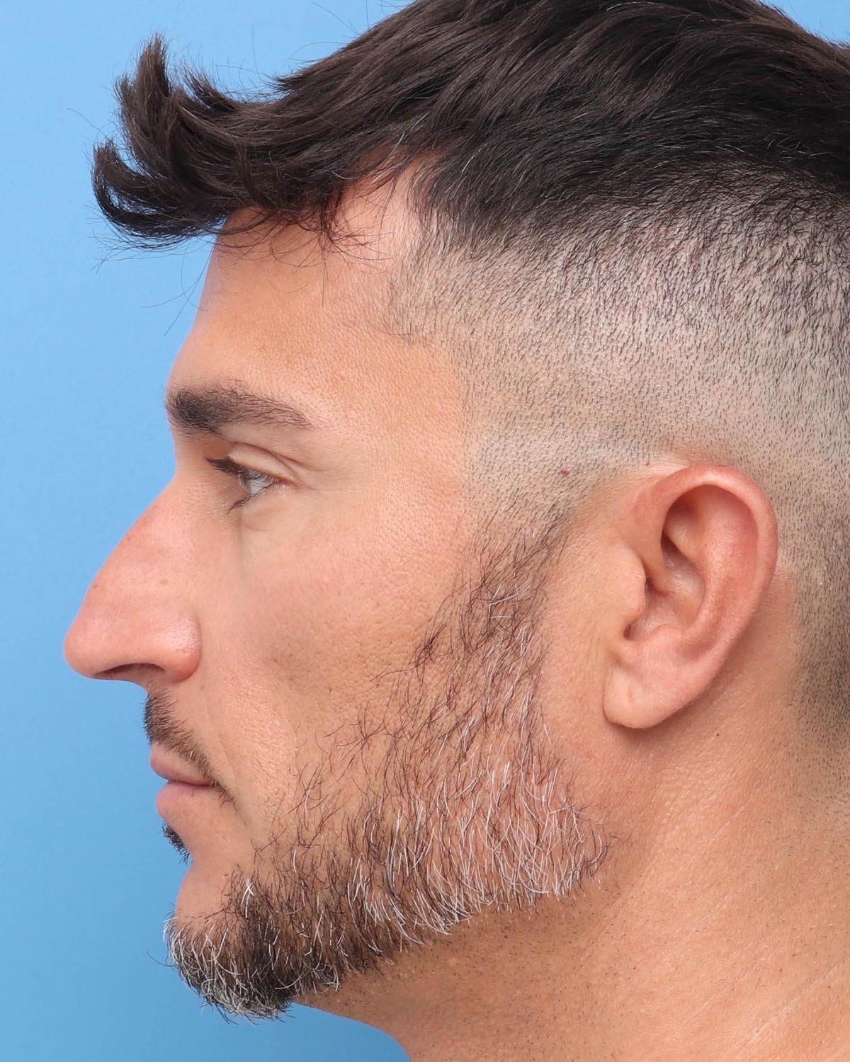 Before Male Rhinoplasty Profile - Vegas Facial Plastics, Mehdi Sina, MD