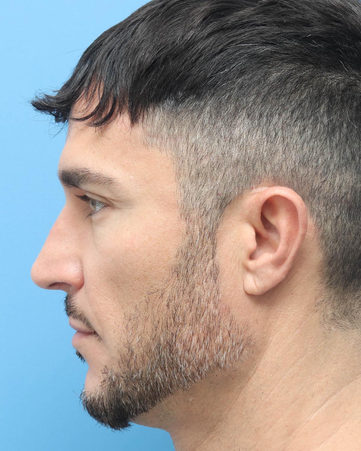 After Male Rhinoplasty Profile - Vegas Facial Plastics, Mehdi Sina, MD