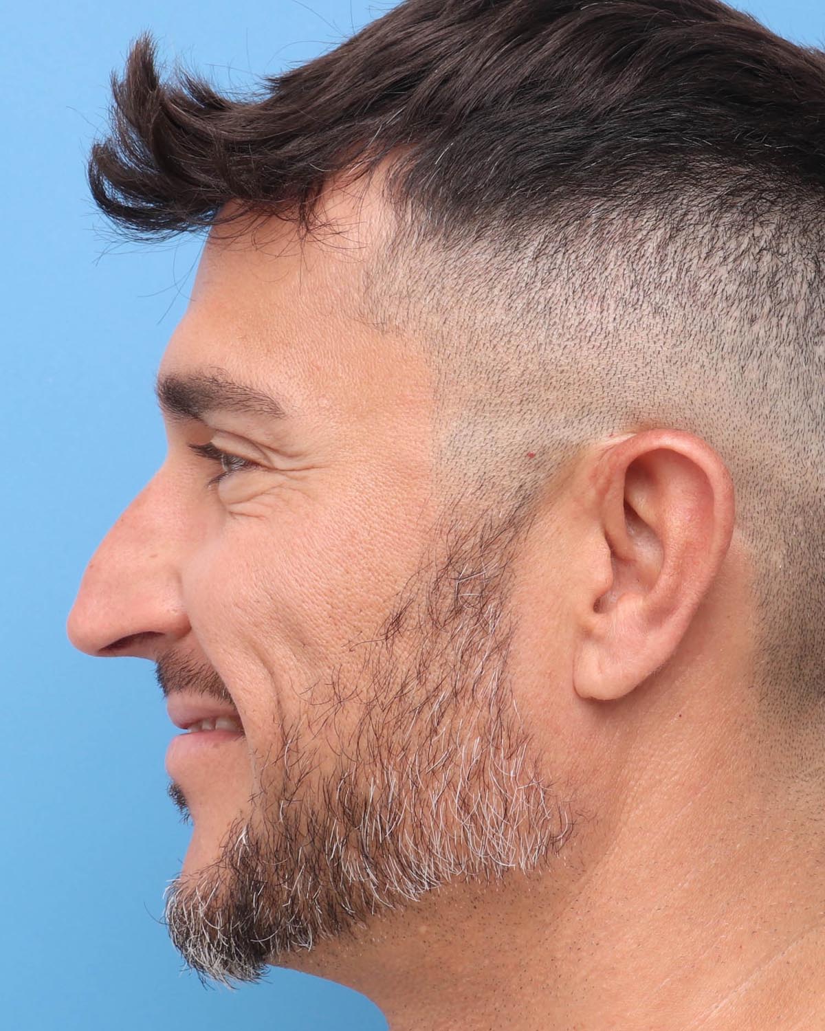 Before Male Rhinoplasty Profile Smiling - Vegas Facial Plastics, Mehdi Sina, MD