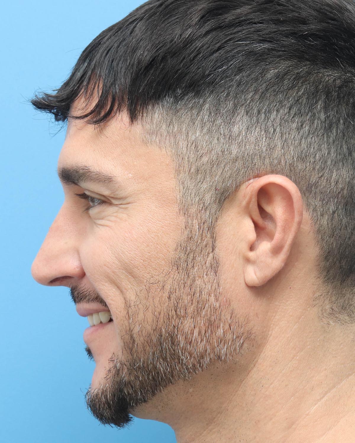 After Male Rhinoplasty Profile Smiling - Vegas Facial Plastics, Mehdi Sina, MD