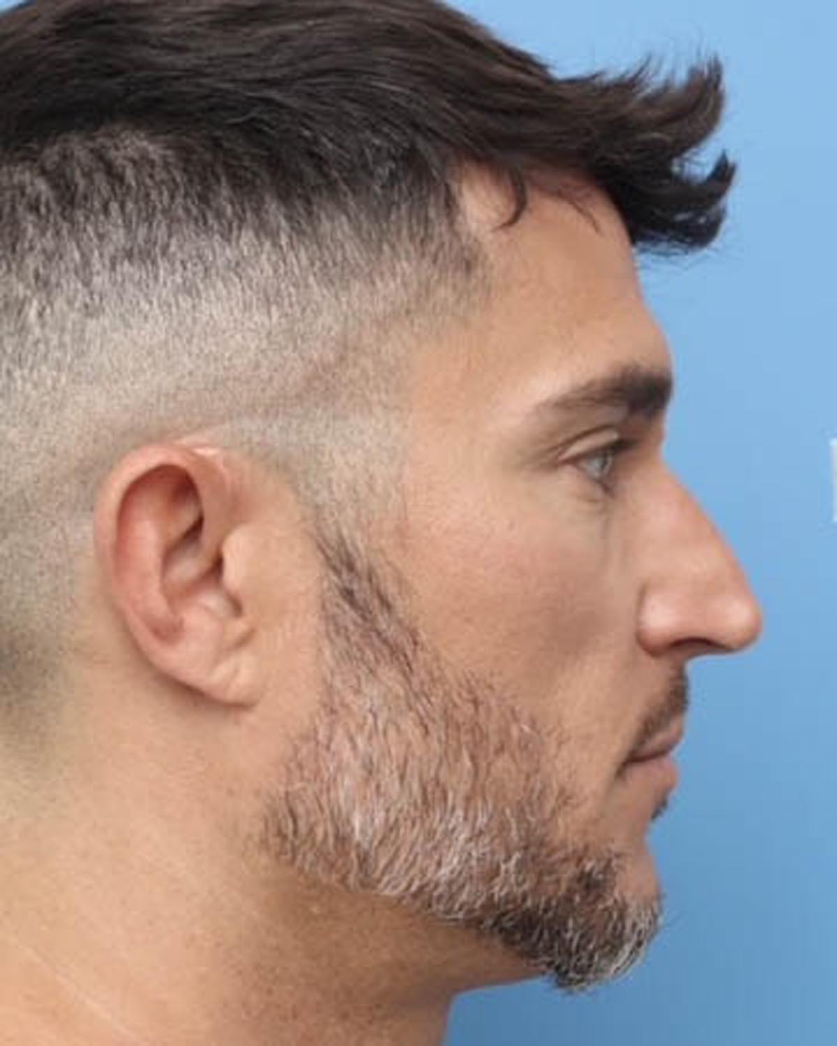 Before Male Rhinoplasty Profile - Vegas Facial Plastics, Mehdi Sina, MD