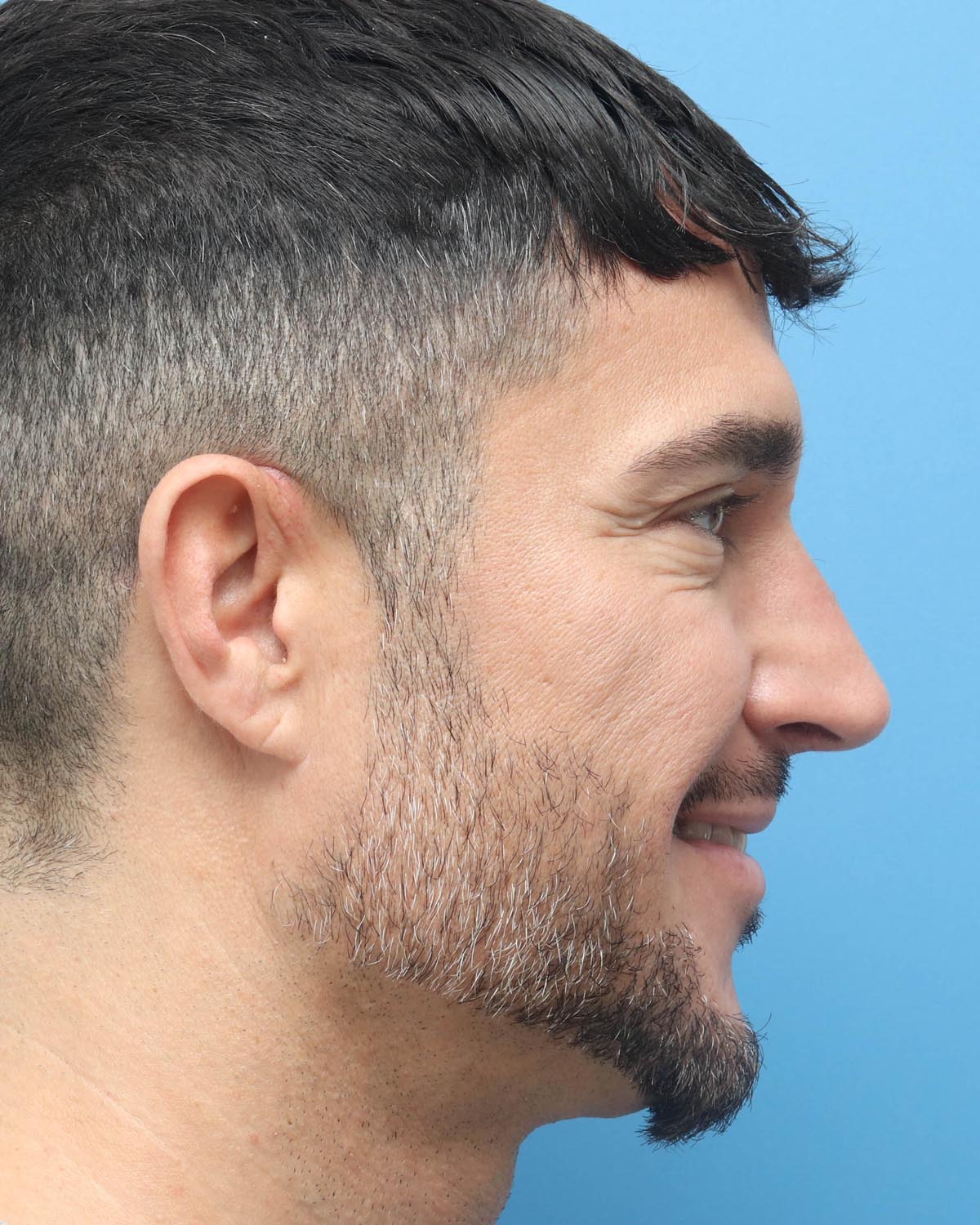 After Male Rhinoplasty Profile Smiling - Vegas Facial Plastics, Mehdi Sina, MD