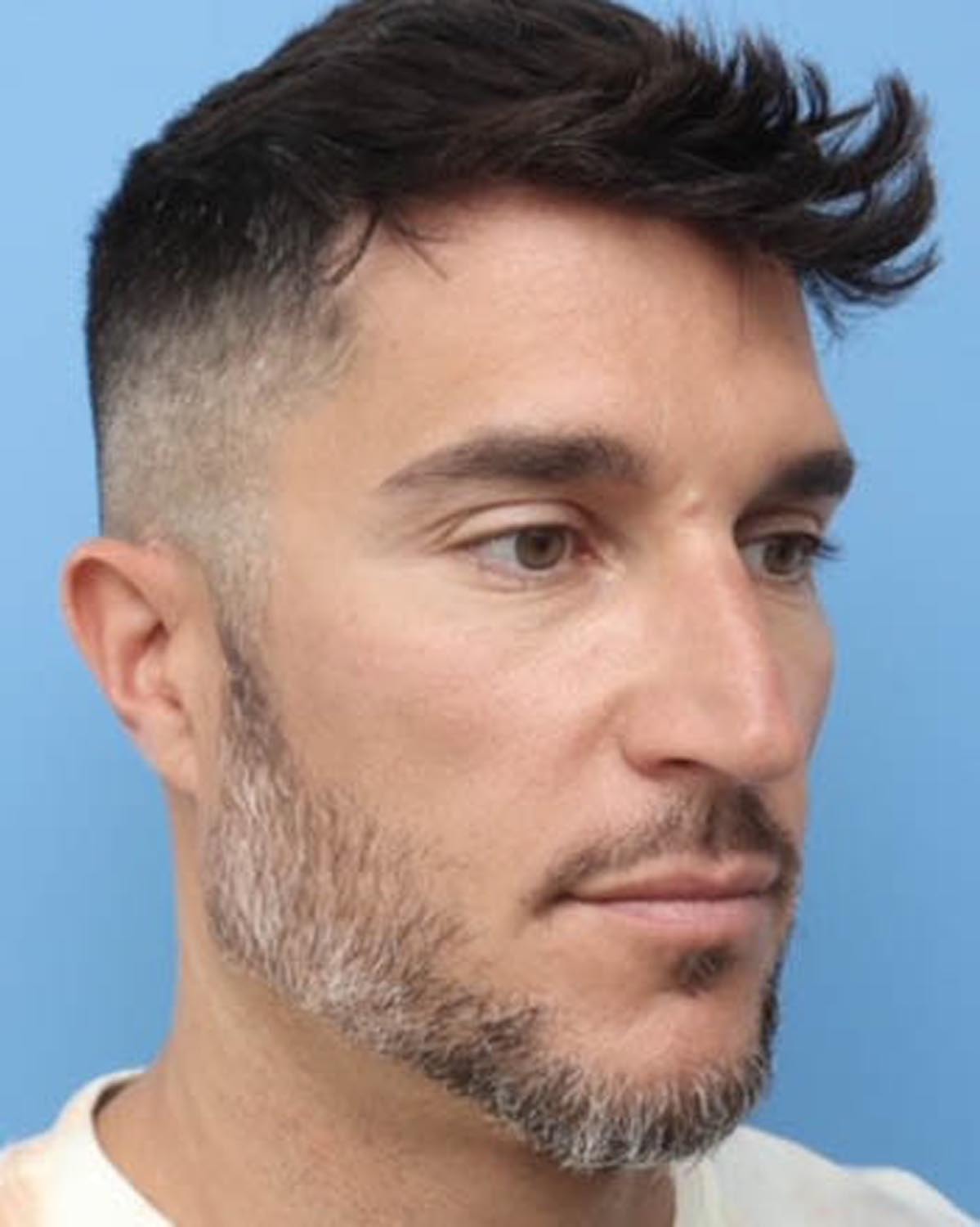 Before Male Rhinoplasty Oblique - Vegas Facial Plastics, Mehdi Sina, MD