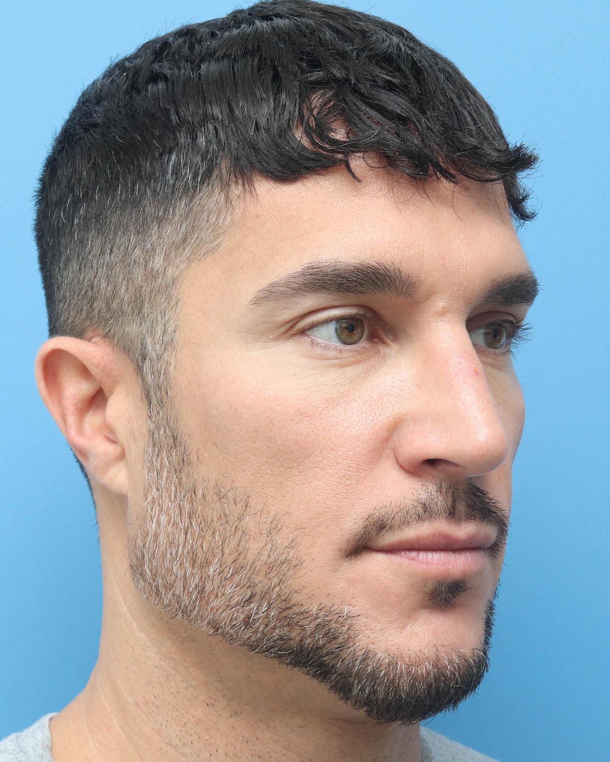 After Male Rhinoplasty Oblique - Vegas Facial Plastics, Mehdi Sina, MD