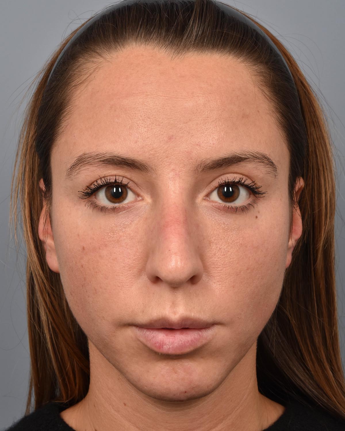 Before Chin Implant & Submental Liposuction