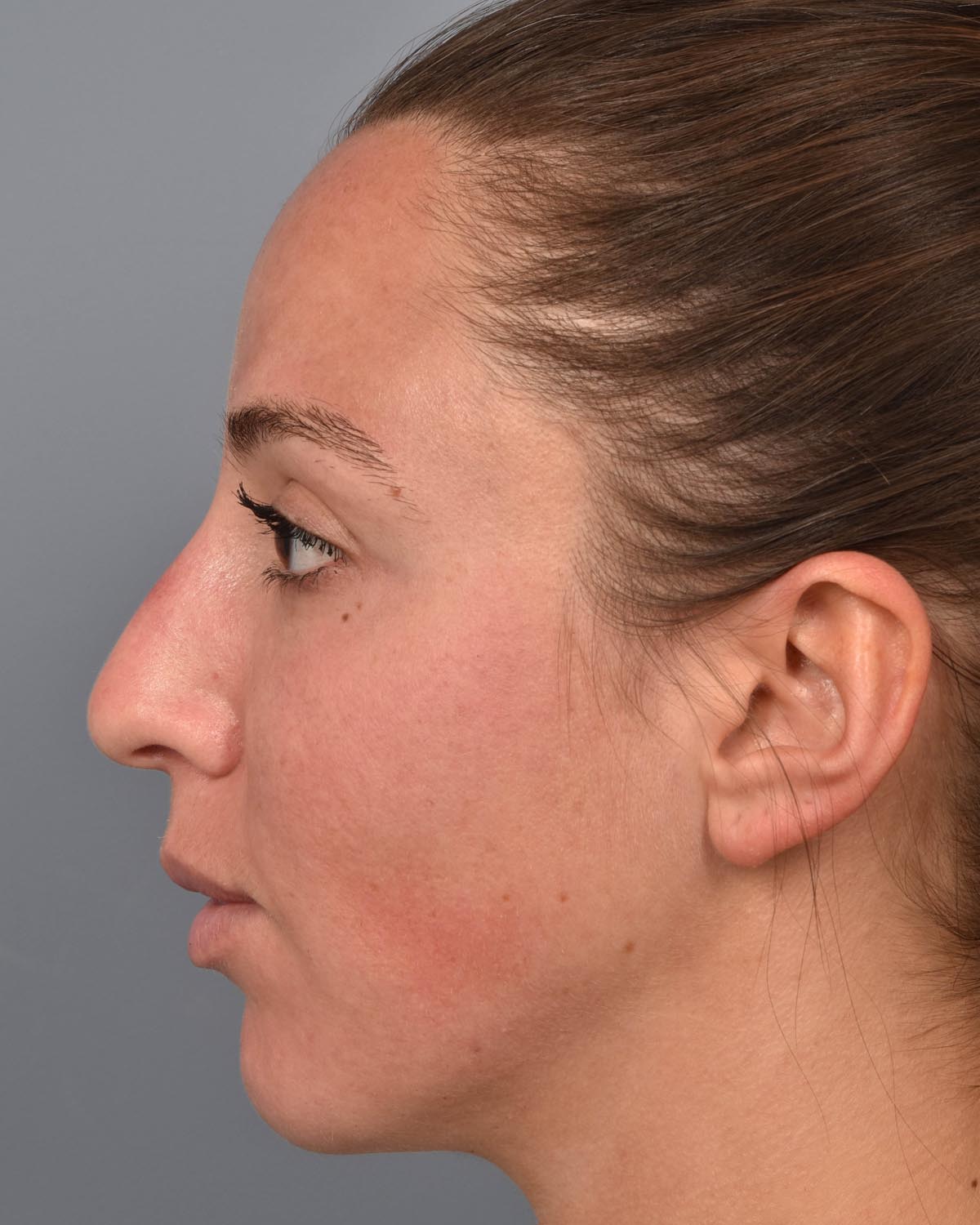 After Chin Implant & Submental Liposuction Profile