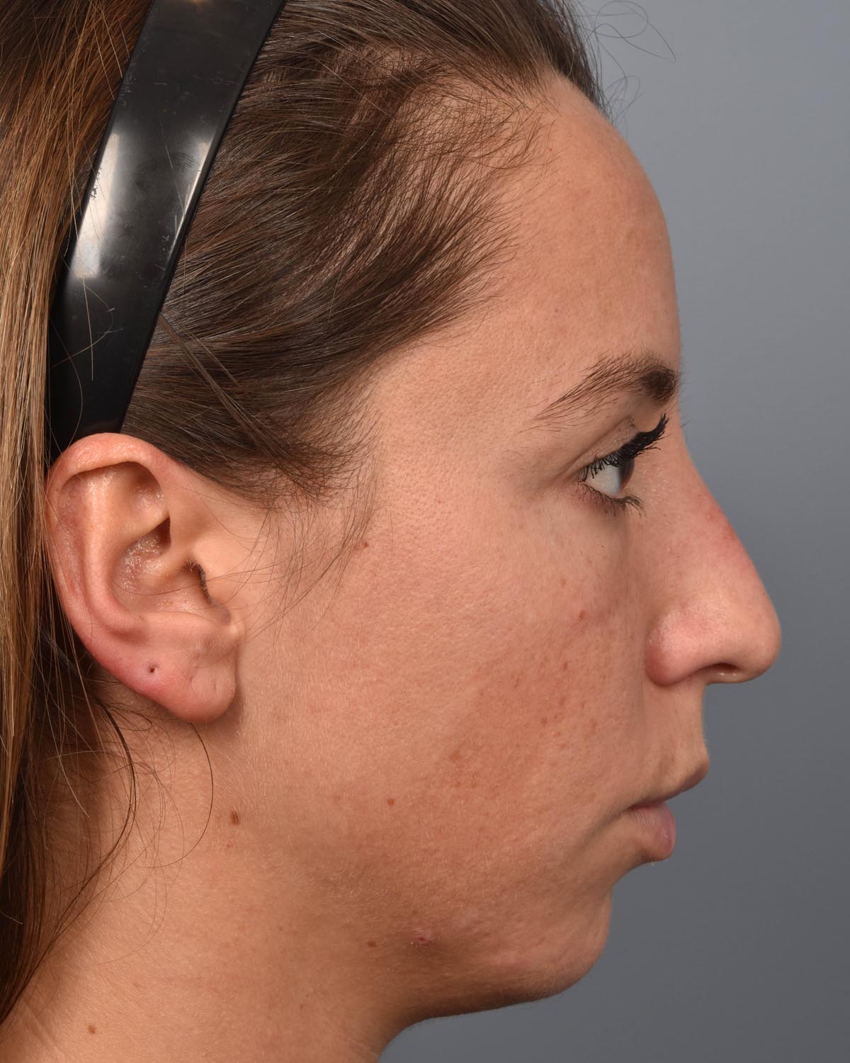 Before Chin Implant & Submental Liposuction Profile