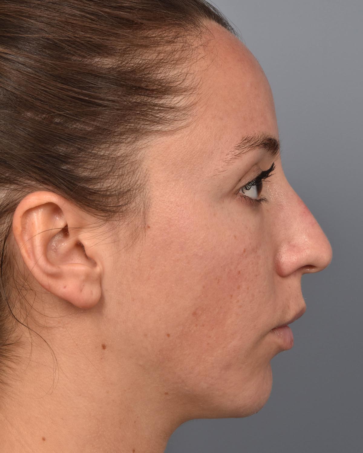 After Chin Implant & Submental Liposuction Profile