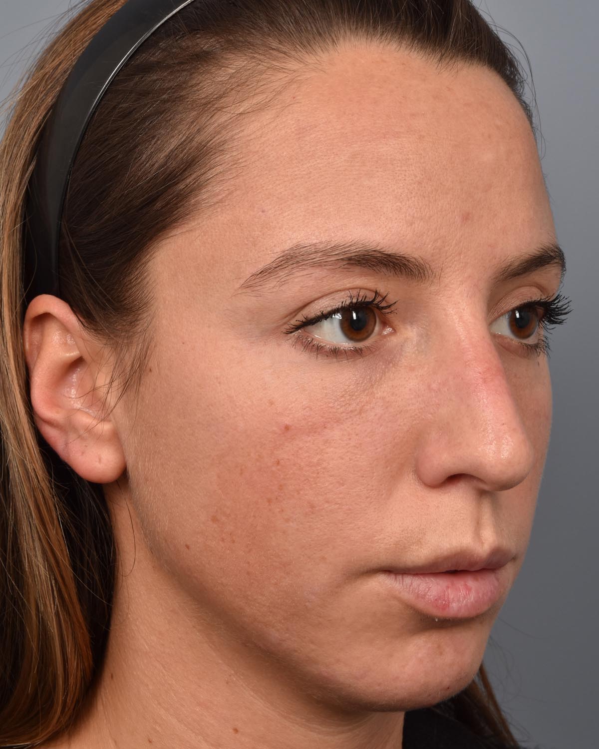 Before Chin Implant & Submental Liposuction Oblique