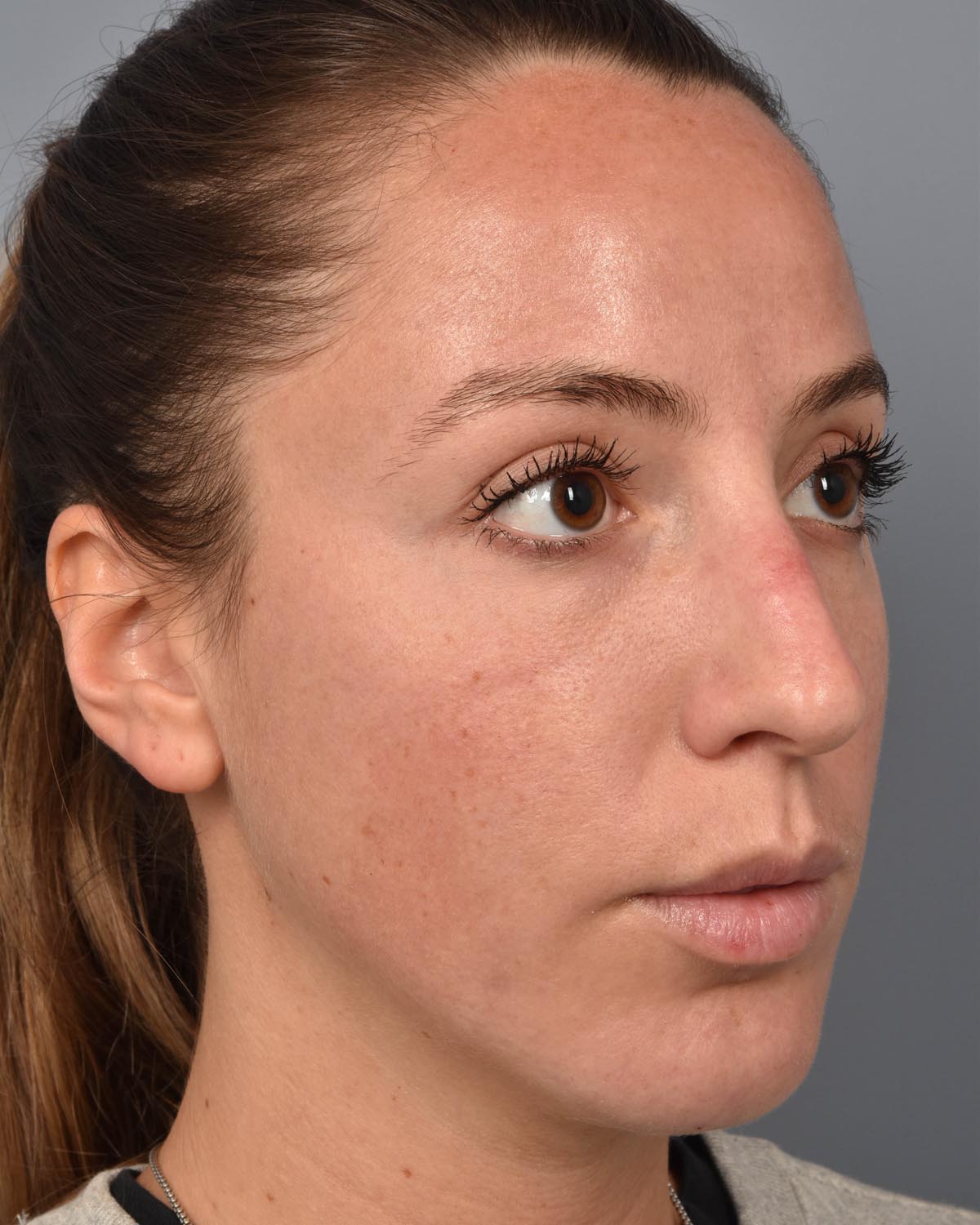 After Chin Implant & Submental Liposuction Oblique