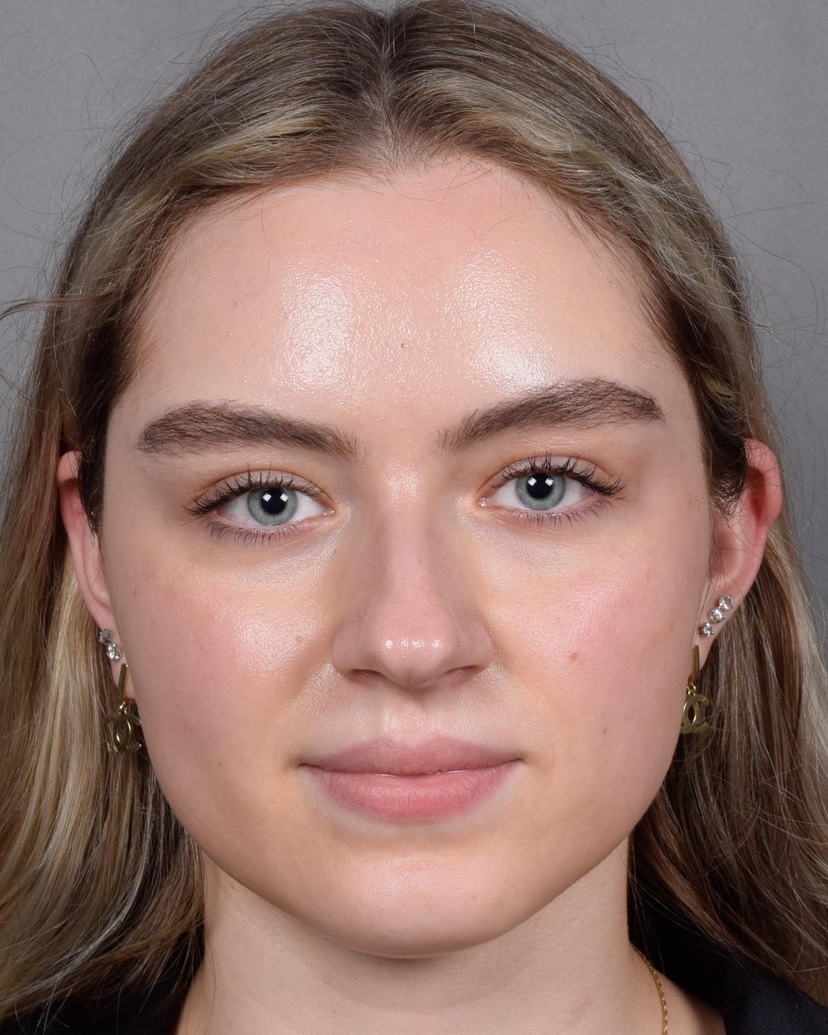 Before Functional Rhinoplasty - Vegas Facial Plastics, Mehdi Sina, MD