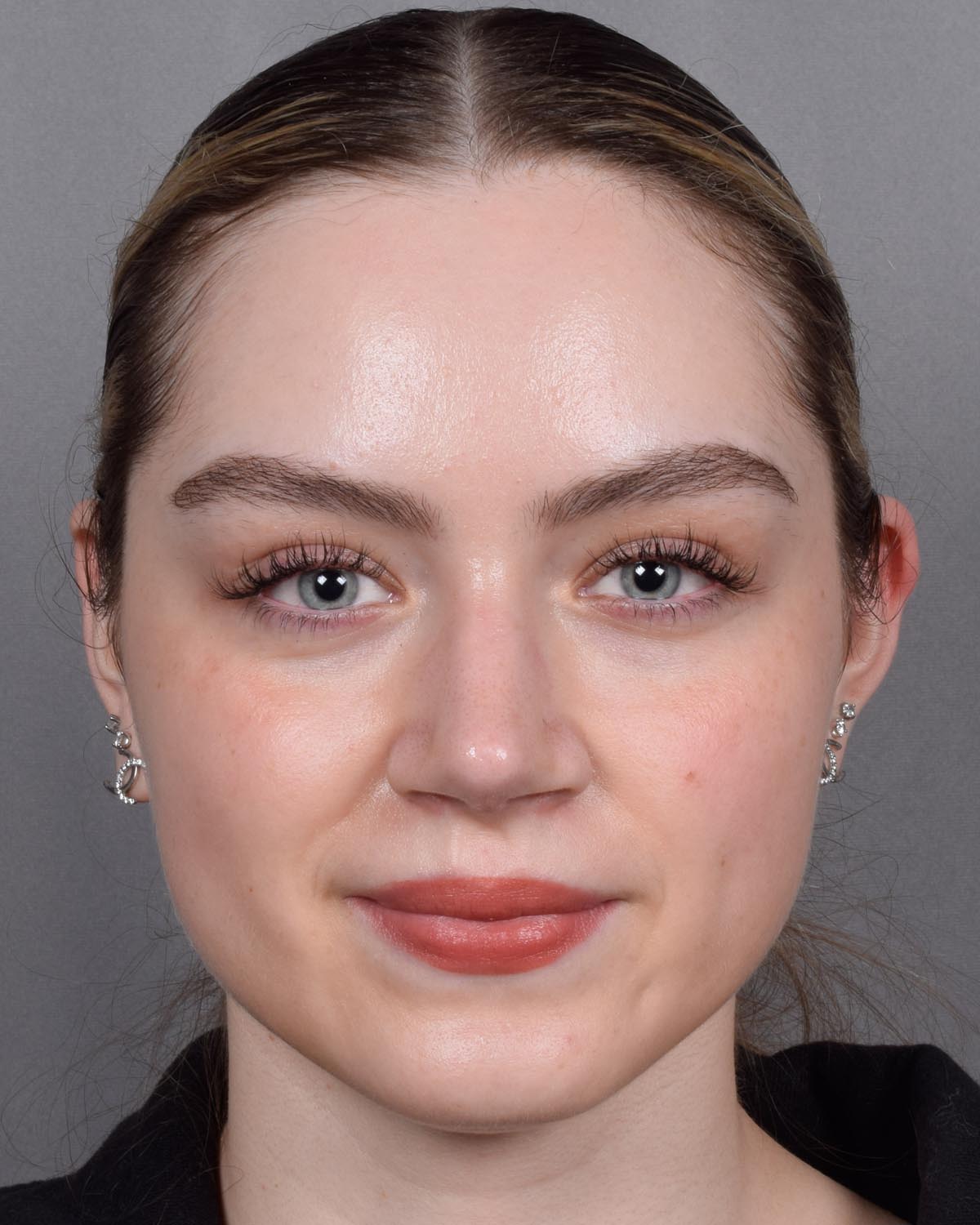 After Functional Rhinoplasty - Vegas Facial Plastics, Mehdi Sina, MD