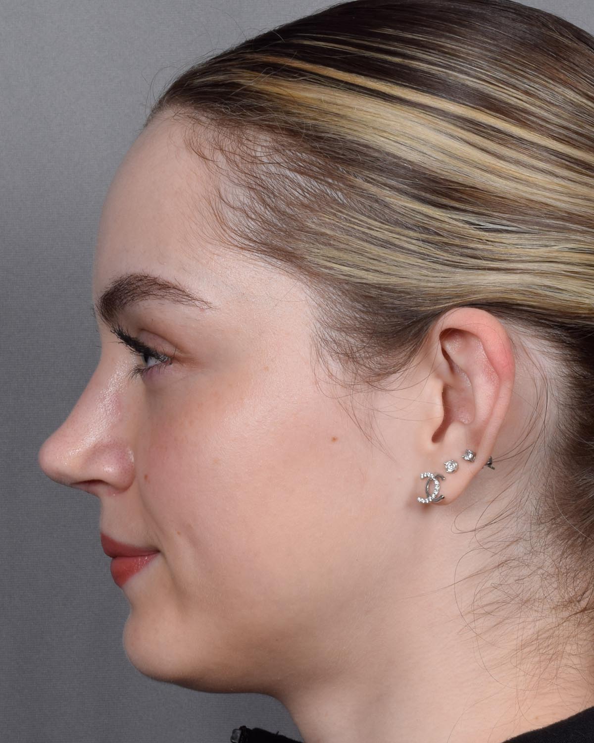 After Functional Rhinoplasty Profile - Vegas Facial Plastics, Mehdi Sina, MD