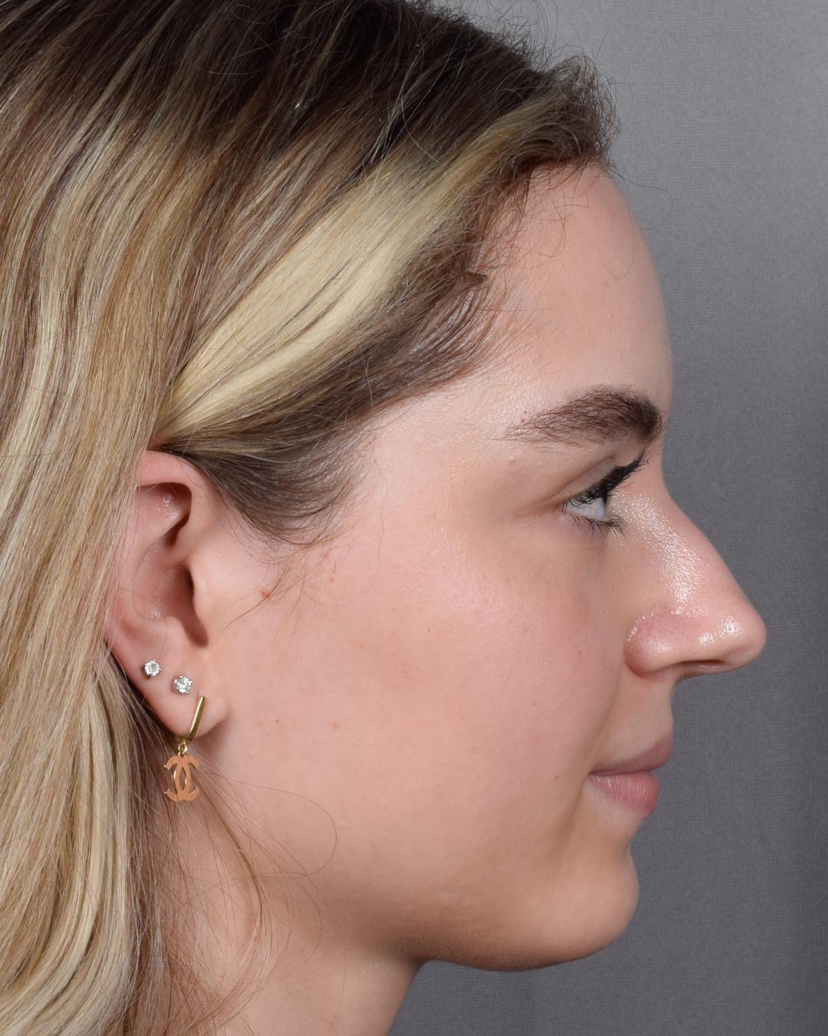 Before Functional Rhinoplasty Profile - Vegas Facial Plastics, Mehdi Sina, MD