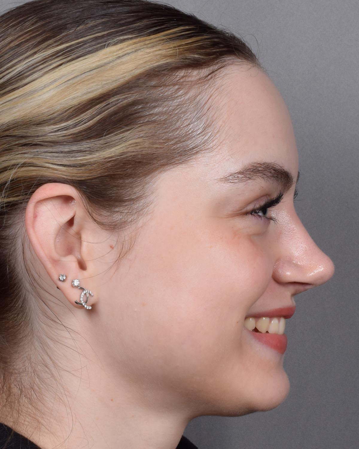 After Functional Rhinoplasty Profile Smiling - Vegas Facial Plastics, Mehdi Sina, MD