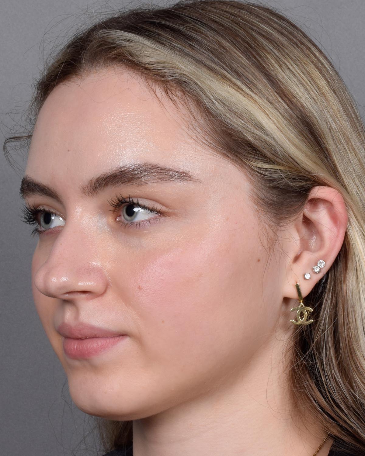 Before Functional Rhinoplasty Oblique - Vegas Facial Plastics, Mehdi Sina, MD