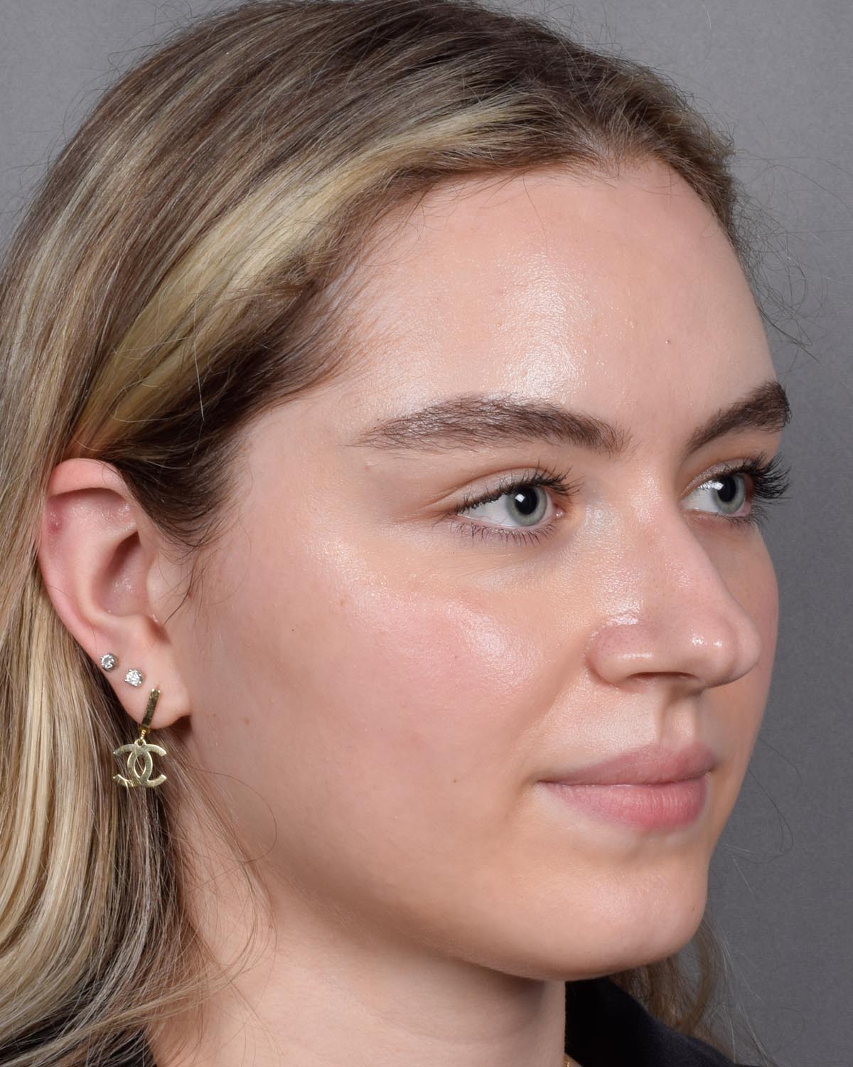 Before Functional Rhinoplasty Oblique - Vegas Facial Plastics, Mehdi Sina, MD