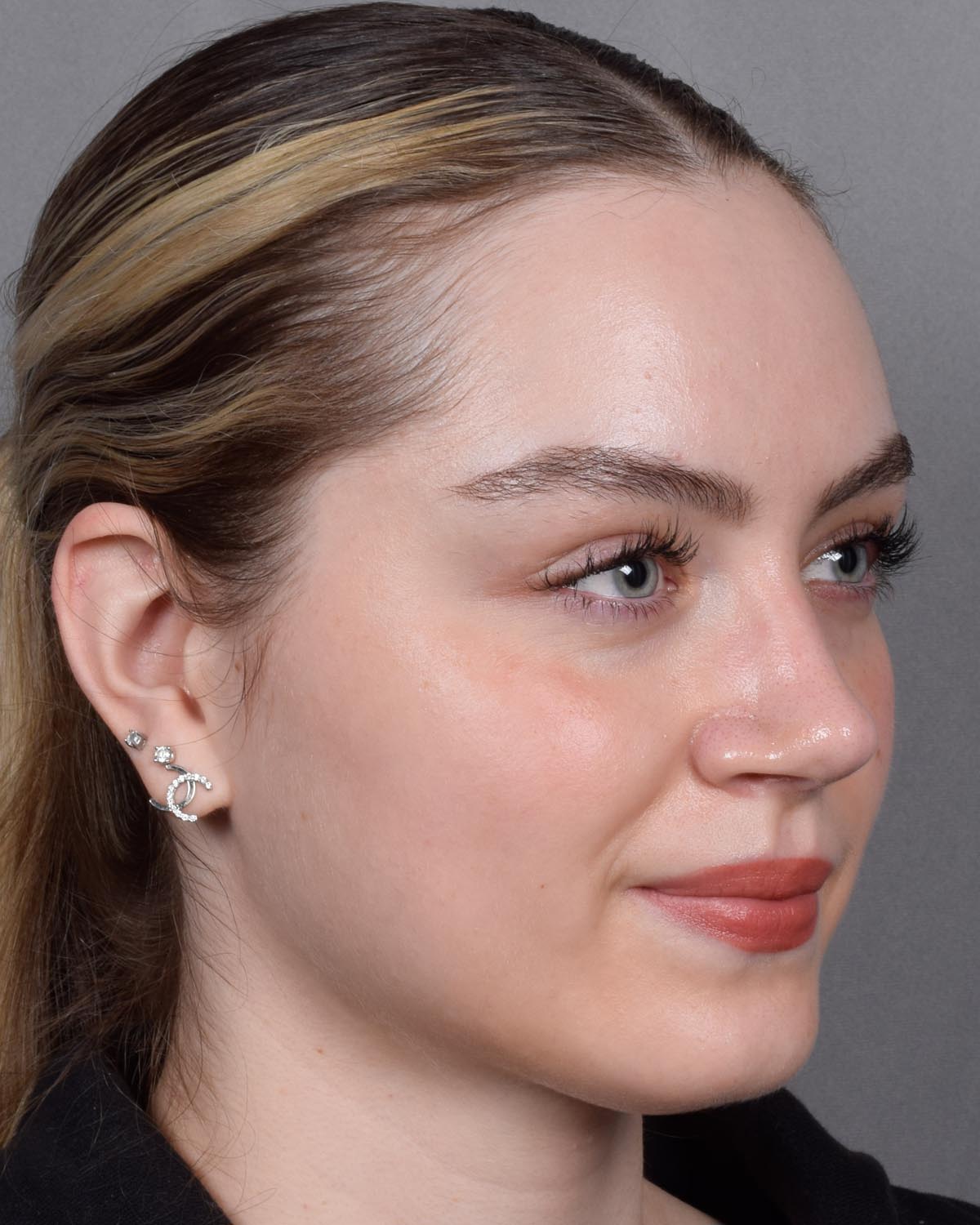 After Functional Rhinoplasty Oblique - Vegas Facial Plastics, Mehdi Sina, MD