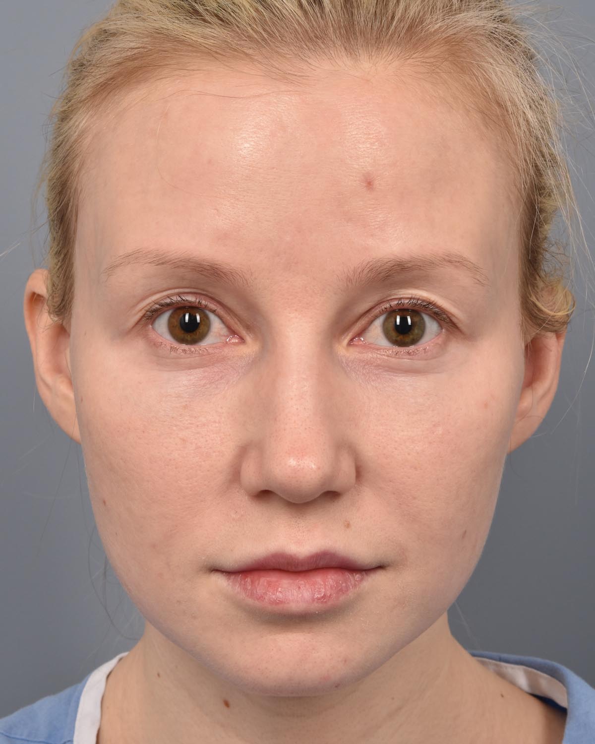 Before Upper Blepharoplasty CB