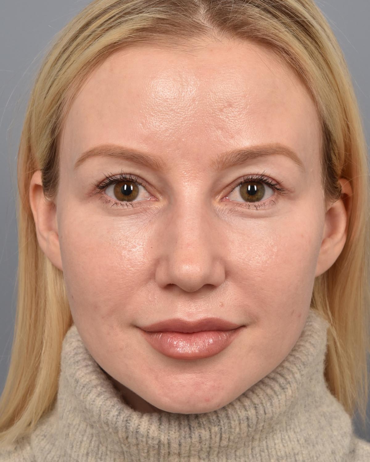 After Upper Blepharoplasty CB
