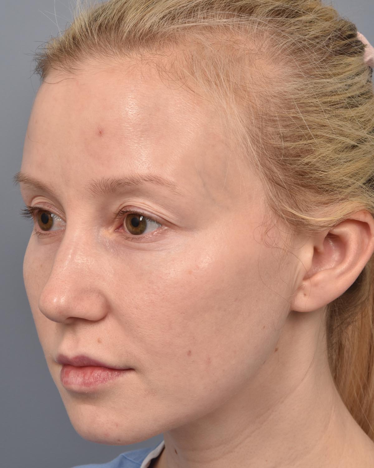 Before Upper Blepharoplasty CB Oblique