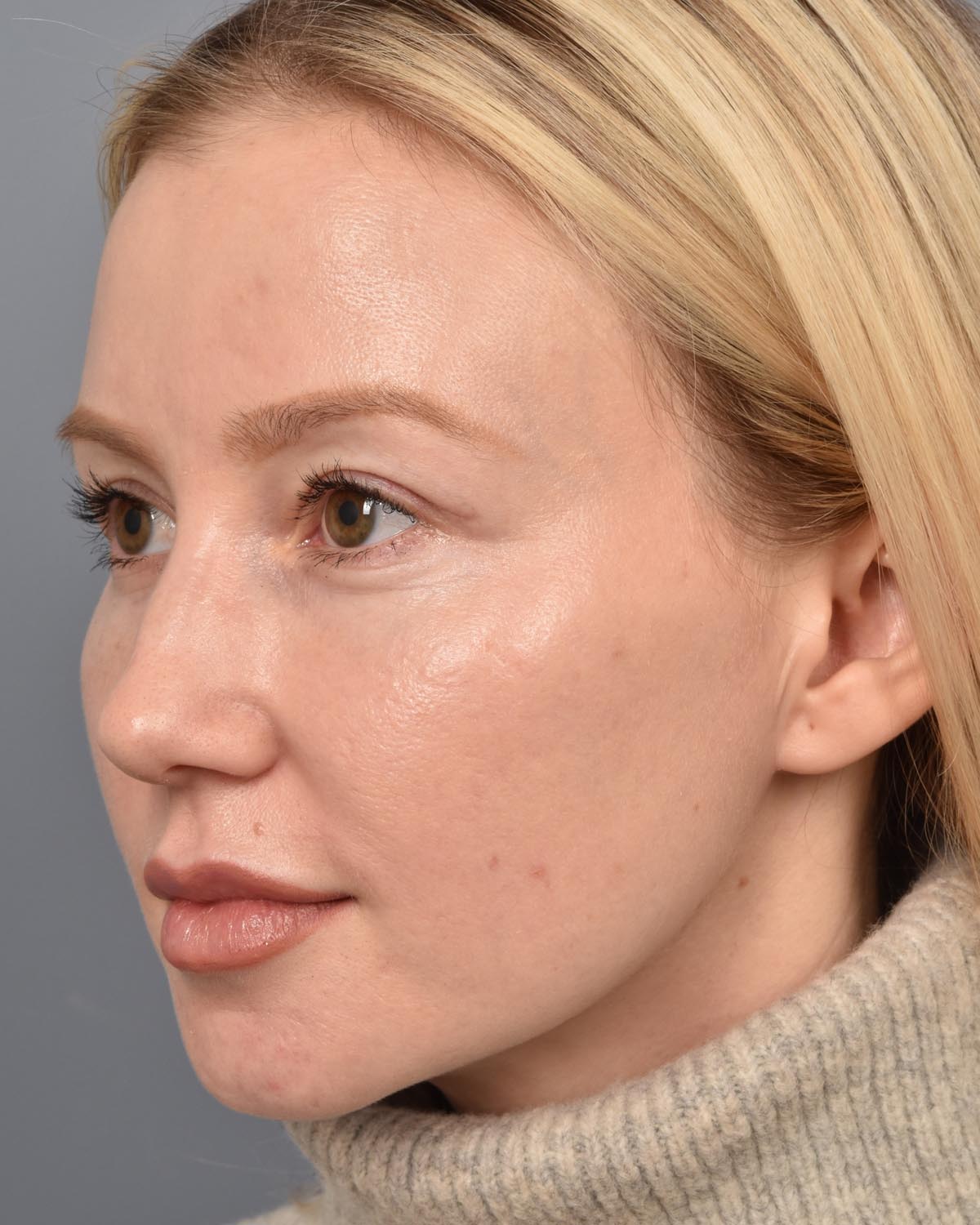 After Upper Blepharoplasty CB Oblique