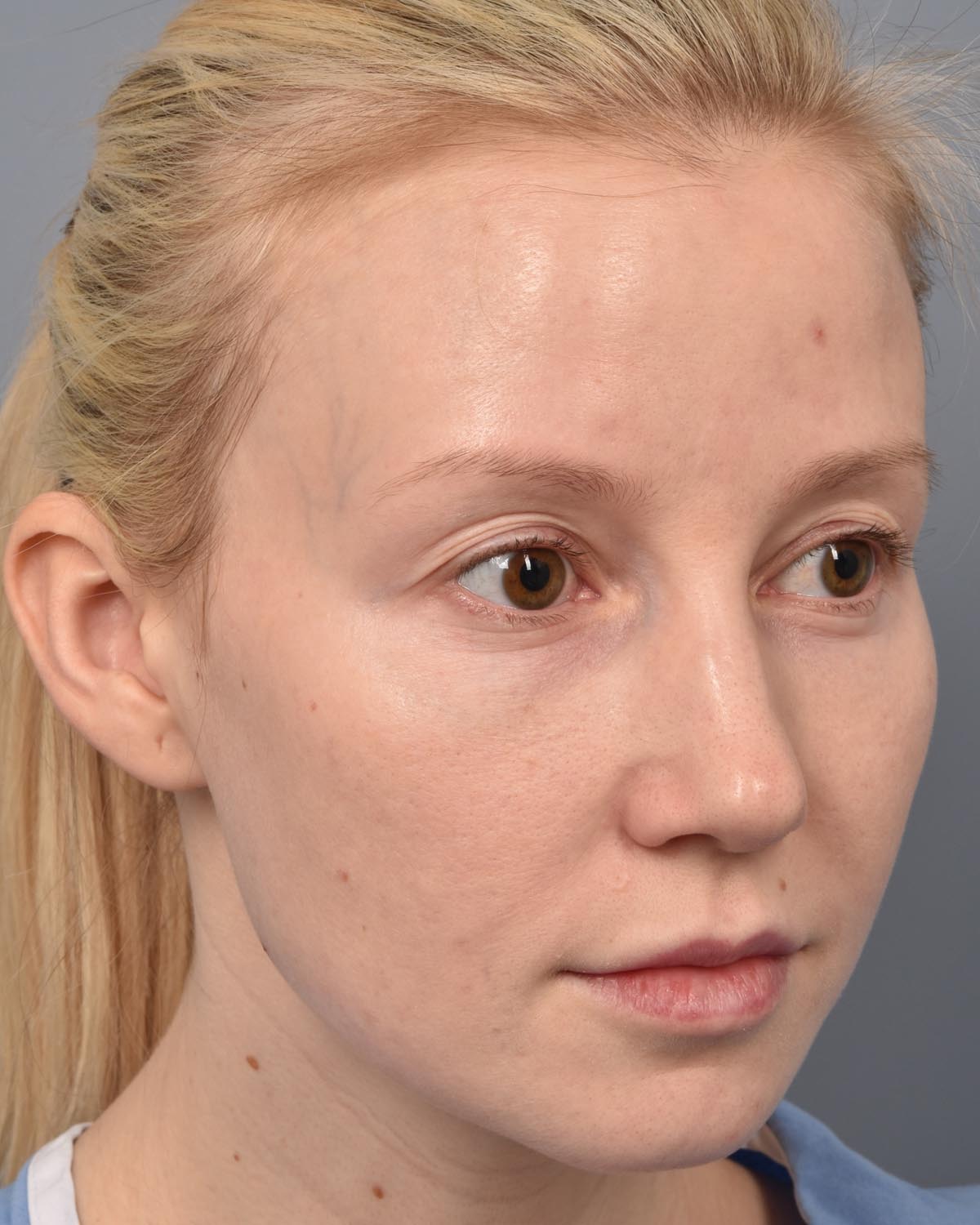 Before Upper Blepharoplasty CB Oblique