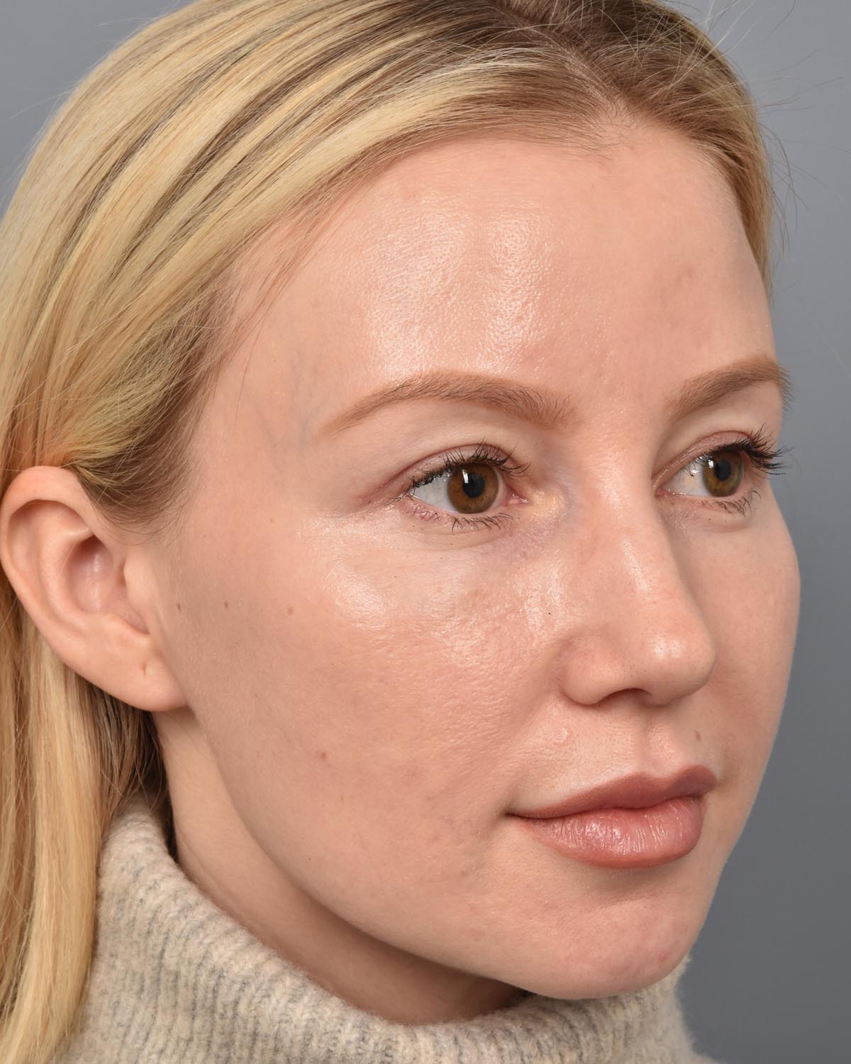 After Upper Blepharoplasty CB Oblique