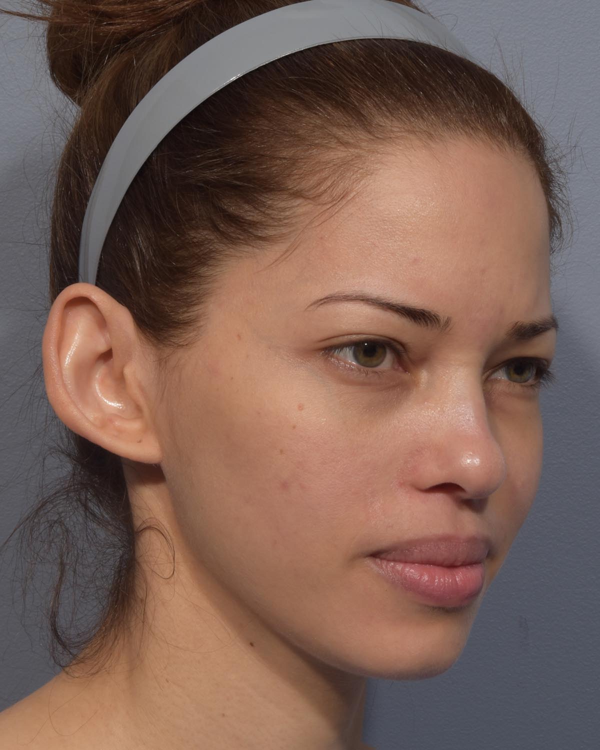 Before Otoplasty (Ear Surgery) Oblique - Vegas Facial Plastics, Mehdi Sina, MD