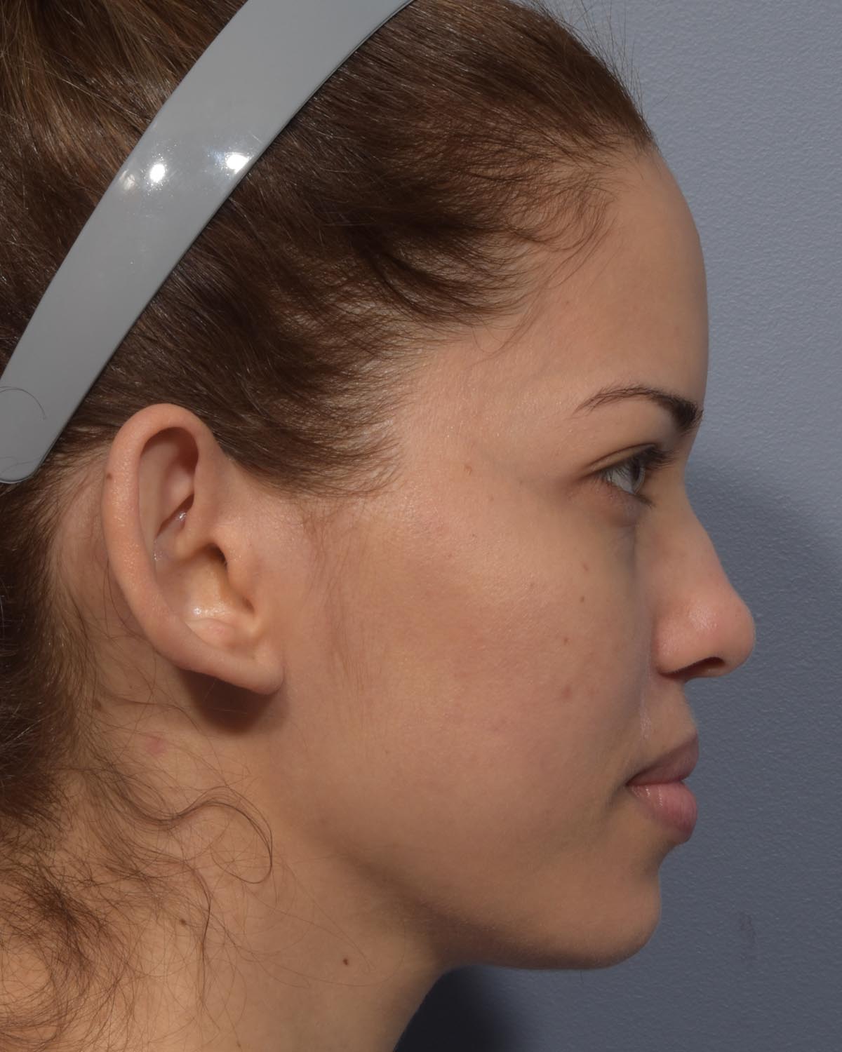 Before Otoplasty (Ear Surgery) Profile - Vegas Facial Plastics, Mehdi Sina, MD