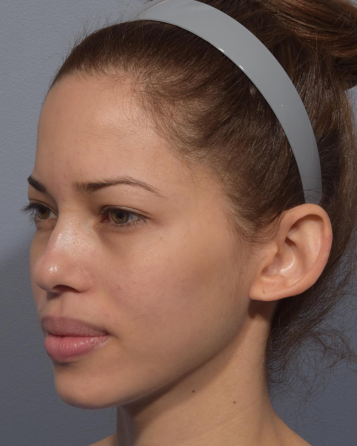 Before Otoplasty (Ear Surgery) Oblique - Vegas Facial Plastics, Mehdi Sina, MD