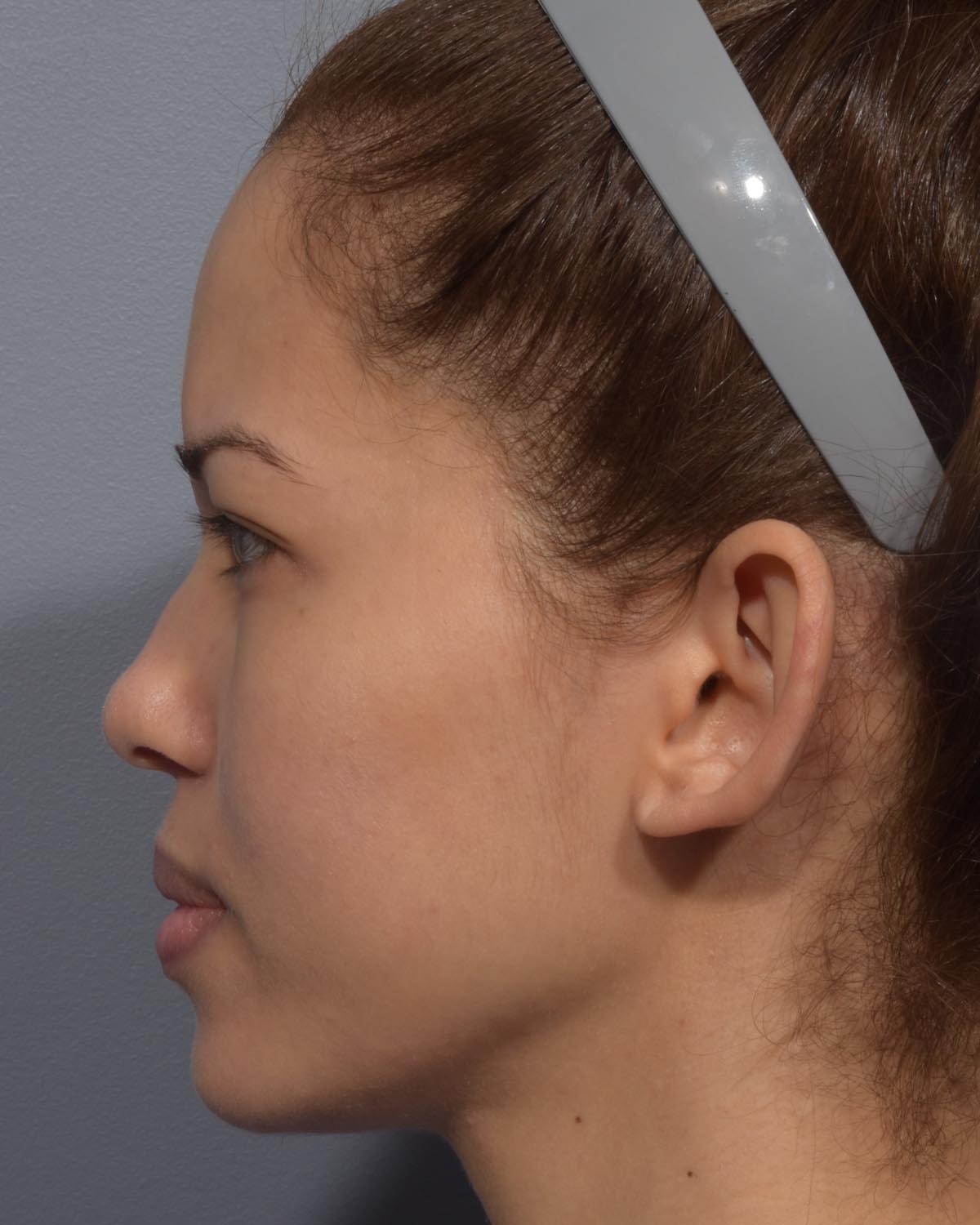 Before Otoplasty (Ear Surgery) Profile - Vegas Facial Plastics, Mehdi Sina, MD