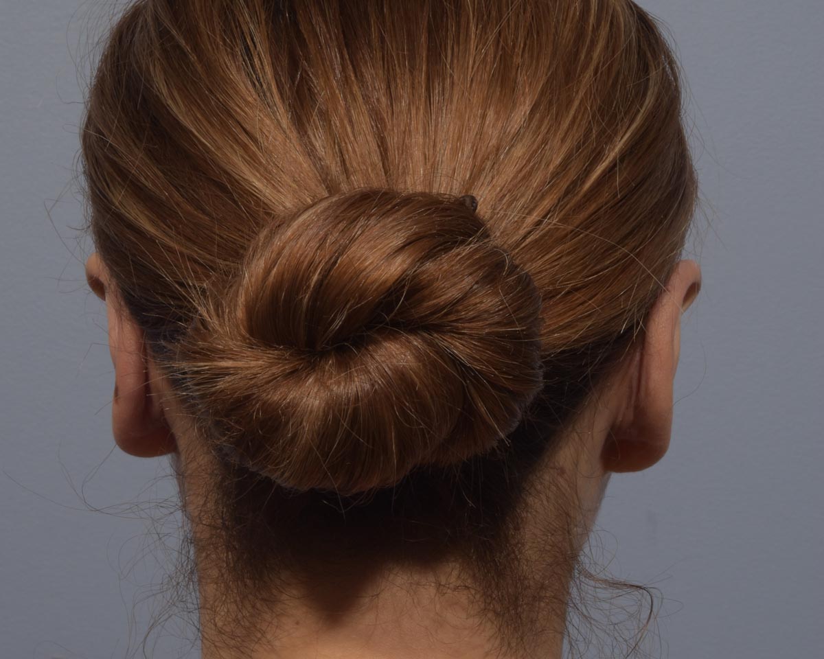 After Otoplasty (Ear Surgery) Back View - Vegas Facial Plastics, Mehdi Sina, MD